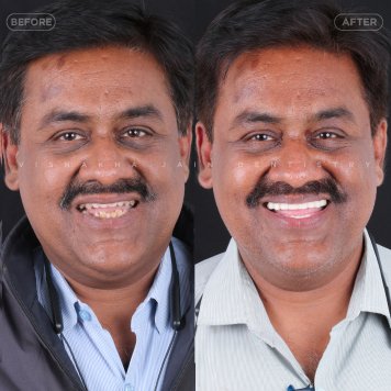 Cosmetic Dental Caps for Smile Perfection in Indore
