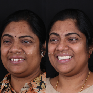 Expert Tooth Cap Solutions at the Best Dental Clinic in Indore