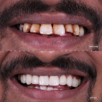 Get Natural-Looking Tooth Crowns in Indore Today