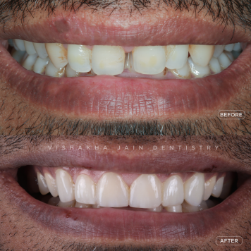 Protect Damaged Teeth with High-Quality Crowns & Caps