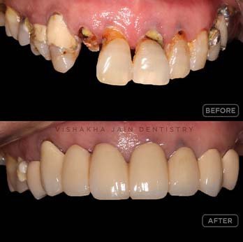 Durable Dental Caps in Indore for a Stronger Smile