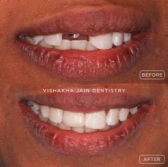 Zirconia & Ceramic Tooth Caps at Seraphic Dental Clinic