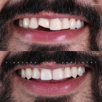 Transform Your Smile Instantly with Veneers in Indore