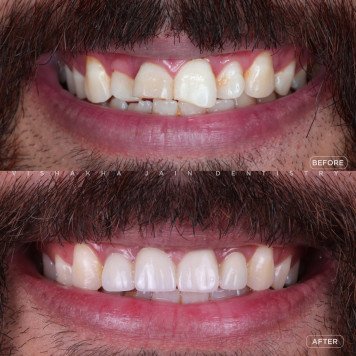 Smile Makeover with Veneers – Book in Indore Today