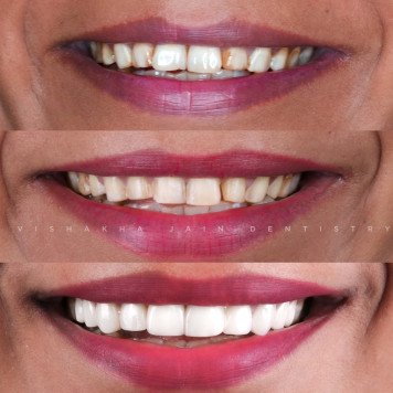 Porcelain & Composite Veneers at Seraphic Dental Clinic