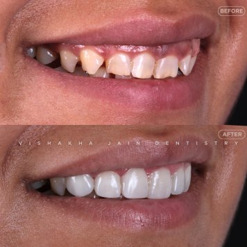 Expert Smile Design with Veneers by Dr. Ankit & Dr. Vishakha