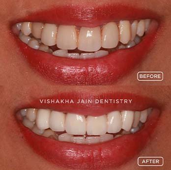 Get the Perfect Smile with Dental Veneers in Indore