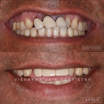 Cosmetic Solutions for Chipped Teeth at Seraphic Dental