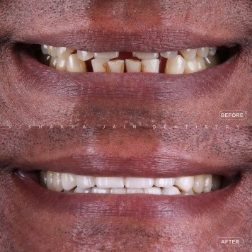 Get Quick & Affordable Chipped Tooth Repair Today