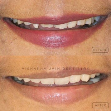 Fix Chipped or Broken Teeth with Painless Dental Care