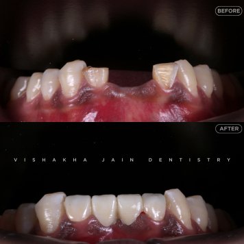 Broken or Chipped Tooth? Visit Indore’s Trusted Dental Experts