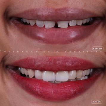 Say Goodbye to Gapped Teeth – Smile with Confidence