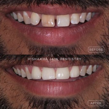 Close Teeth Gaps with Advanced Dental Treatments
