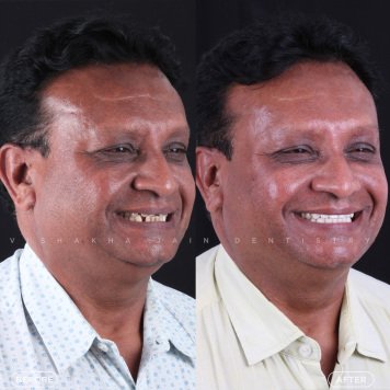 Restore Your Smile with Advanced Dental Implants in Indore