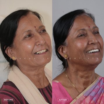 Get Full Mouth Fixed Teeth in Just 1 Day at Seraphic Dental