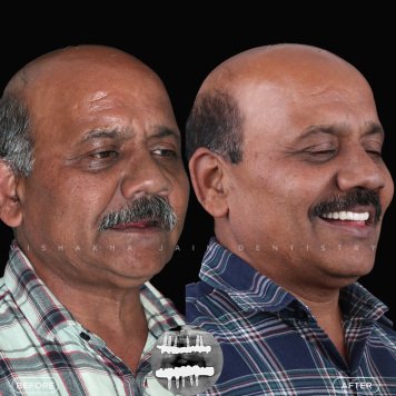 Restore Your Smile with Dental Implants in Indore