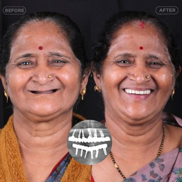 Get Permanent Teeth in 1 Day with Advanced Implants in Indore