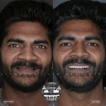 Full Mouth Fix Teeth in Just 1 Day – Smile Confidently Again
