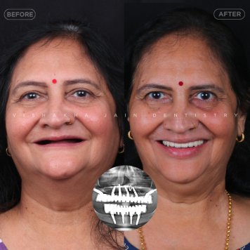 1-Day Full Mouth Fix Teeth at Indore’s Trusted Dental Clinic