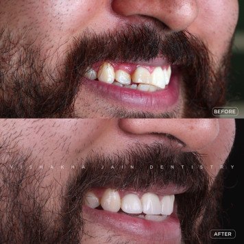 Seraphic Dental in Indore offers complete dental care—whether you're suffering from missing teeth, dental pain, or looking for advanced teeth whitening, smile designing, or a perfect wedding smile makeover. We also specialize in kids dentistry and provide premium care for overseas patients seeking expert and affordable dental treatment in India.