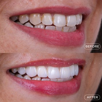 Seraphic Dental offers expert care for missing teeth, dental pain, and advanced teeth whitening solutions in Indore. From smile designing and wedding smiles makeovers to gentle kids dentistry and tailored services for overseas patients, our clinic ensures comfort, aesthetics, and lasting results. Visit the trusted name in dental care — Seraphic Dental, Indore.