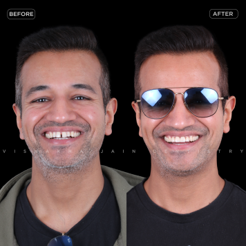 Seraphic Dental Indore offers expert care for missing teeth, dental pain, whitening, smile makeovers, kids dentistry & overseas patients.