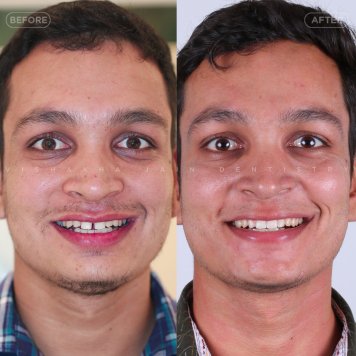 Invisible Teeth Braces in Indore – No Wires, No Hassle