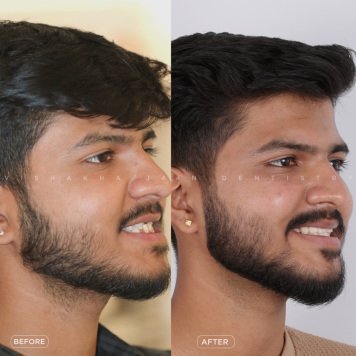 Clear Braces for a Confident, Beautiful Smile