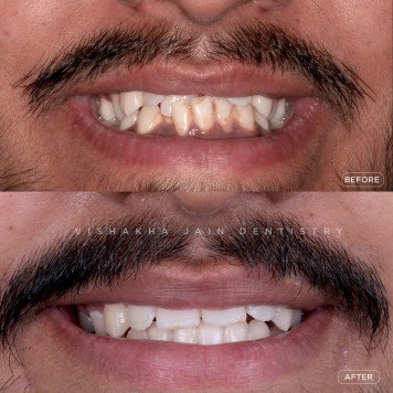 Invisible Braces – The Modern Way to Align Your Teeth