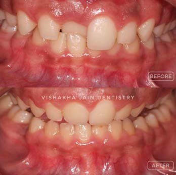 Straighten Your Teeth with Invisible Braces in Indore