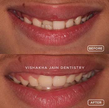 Discreet & Comfortable Invisible Braces for Adults