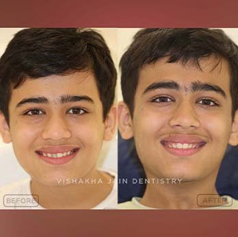 Get a Perfect Smile with Clear Aligners at Seraphic Dental