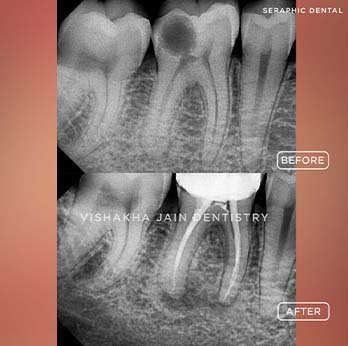 ROOT-CANAL