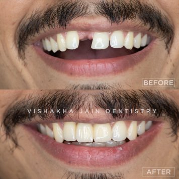 Missing Teeth? Restore Your Smile with Dental Implants