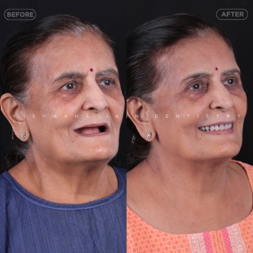 Affordable Treatment for Missing Teeth in Indore