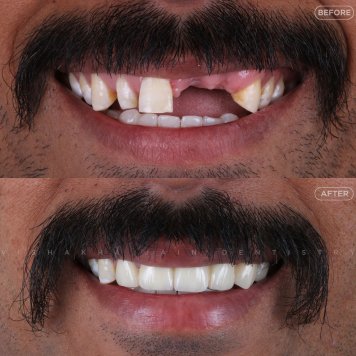Missing Teeth Problems? Discover Safe & Lasting Solutions