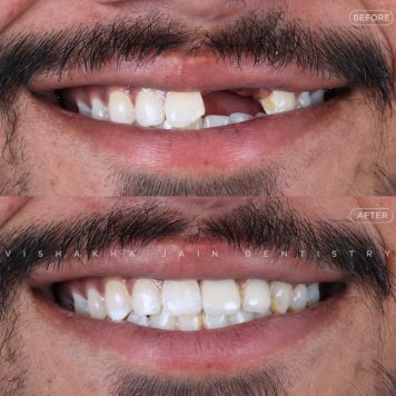 Say Goodbye to Missing Teeth – Smile Confidently Again