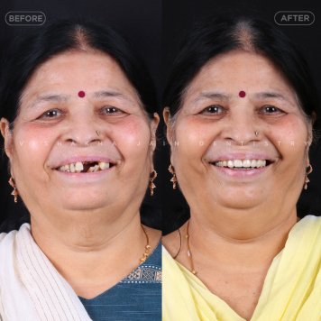 Fix Missing Teeth Permanently with Implants or Bridges