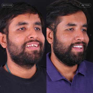 Personalized Smile Design for Natural, Lasting Results