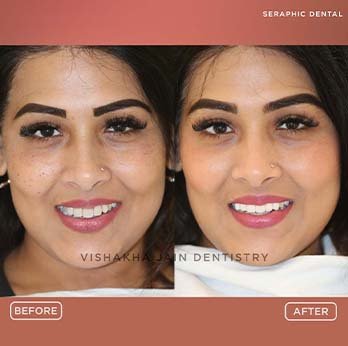 Smile Design in Indore – Transform Your Smile Today