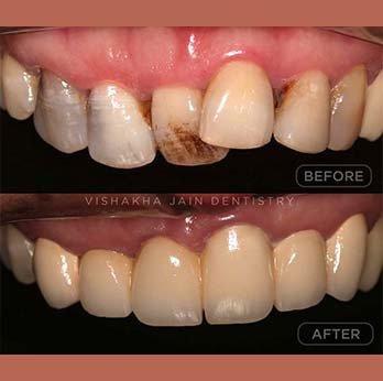Get Perfectly Aligned Teeth with Braces or Clear Aligners
