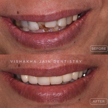 Teeth Alignment Treatment in Indore – Smile Beautifully