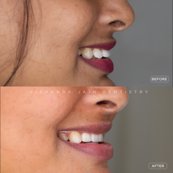 Straighten Your Smile with Painless Teeth Alignment