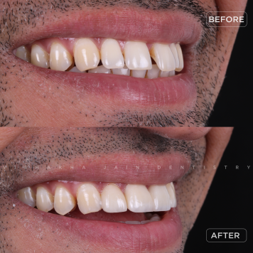 Fix Crooked Teeth with Advanced Orthodontic Treatments