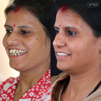 Clear Aligners vs Braces – Best Teeth Alignment Options