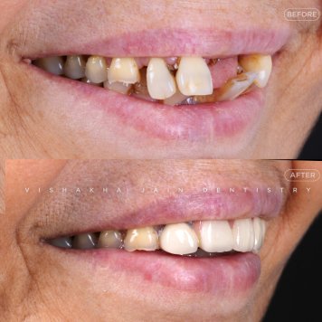 Affordable Teeth Alignment Solutions for All Ages