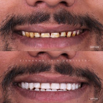Professional Dental Whitening Treatments for a Radiant Smile