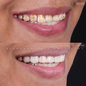 Get Sparkling White Teeth in One Session at Seraphic Dental Indore