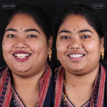 Say Goodbye to Stains – Expert Teeth Whitening at Seraphic Dental