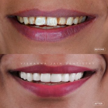 Teeth Whitening in Indore – Brighten Your Smile at Seraphic Dental
